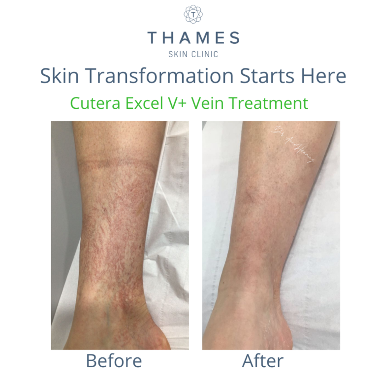Laser Rejuvenation Treatment