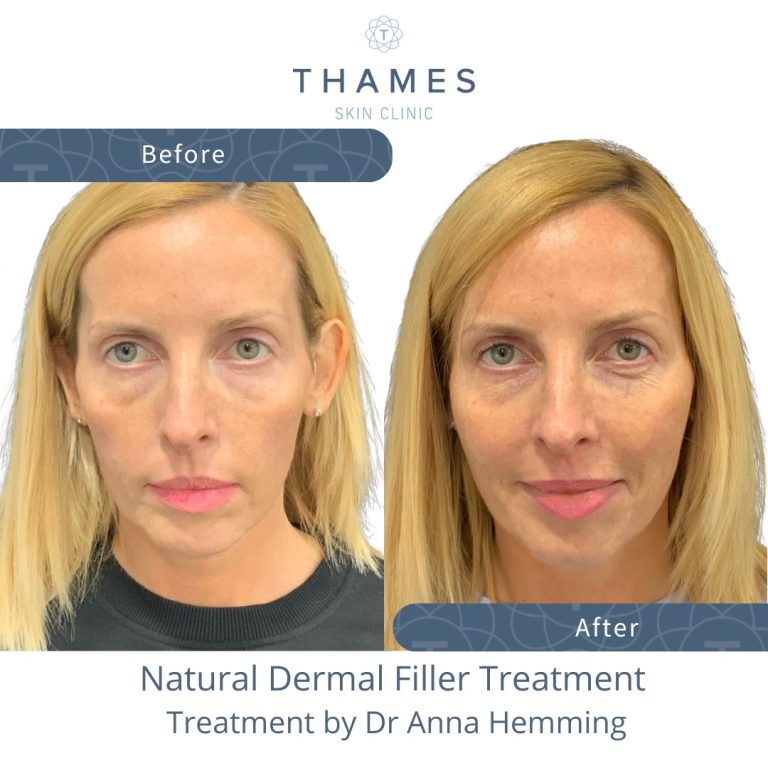 Volume and lifting with natural looking dermal filler Treatment by Dr Anna Hemming at Thames Skin Clinic Twickenham
