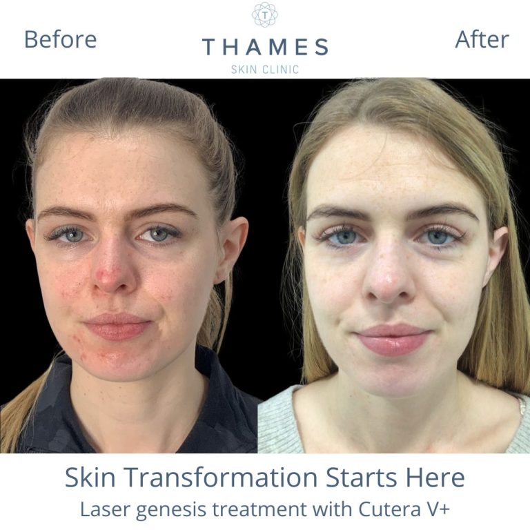 Derma filler Before and aftr at Thames Skin Clinic by Dr Anna Hemming Twickenham skin transformation Cutera