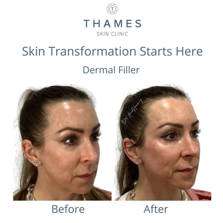 Derma filler Before and aftr at Thames Skin Clinic by Dr Anna Hemming Twickenham skin transformation