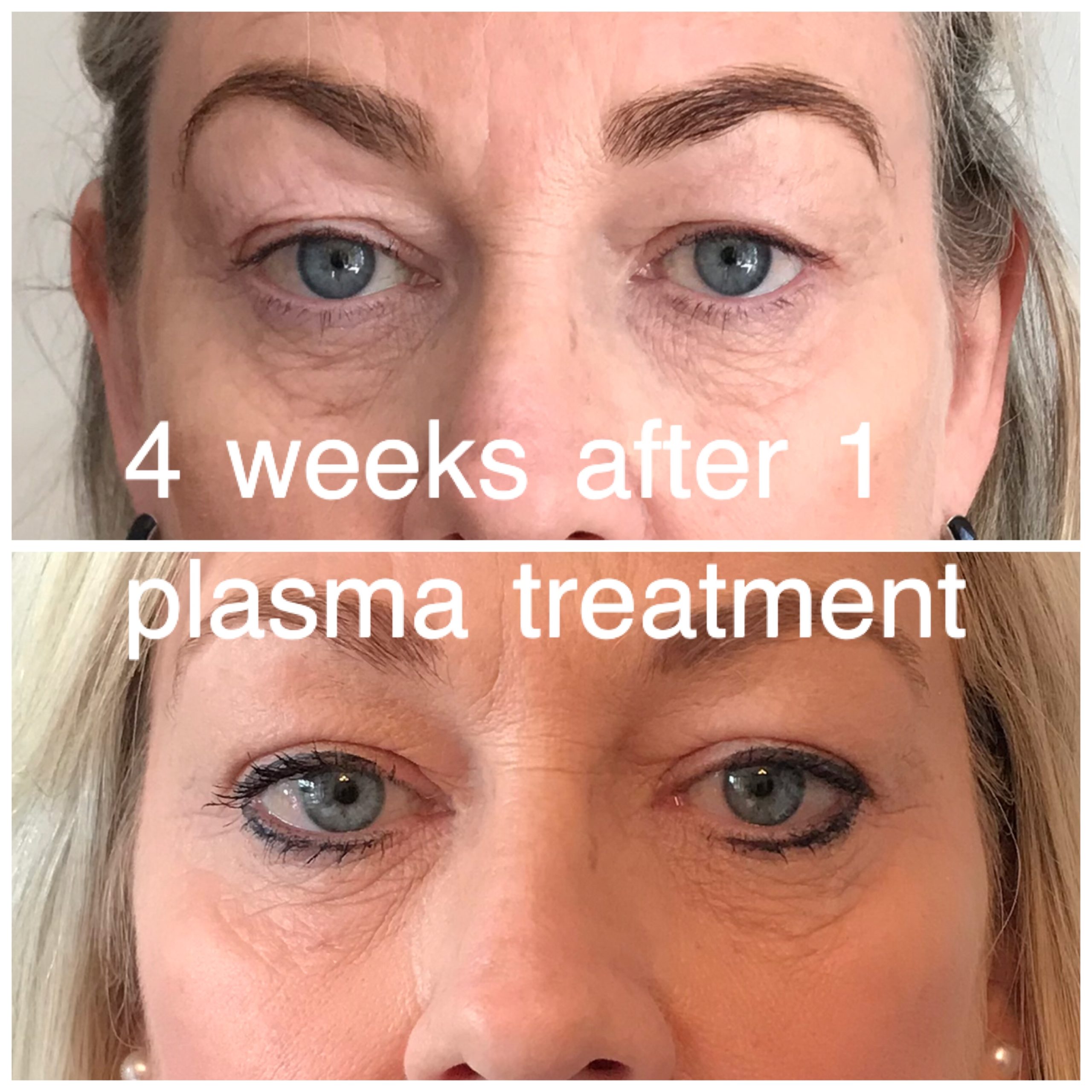 Non Surgical Blepharoplasty Eyelid Tightening Thames Skin Clinic