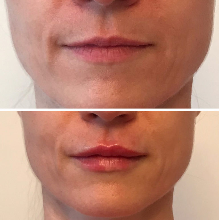 Dermal Filler Before and After Client 4