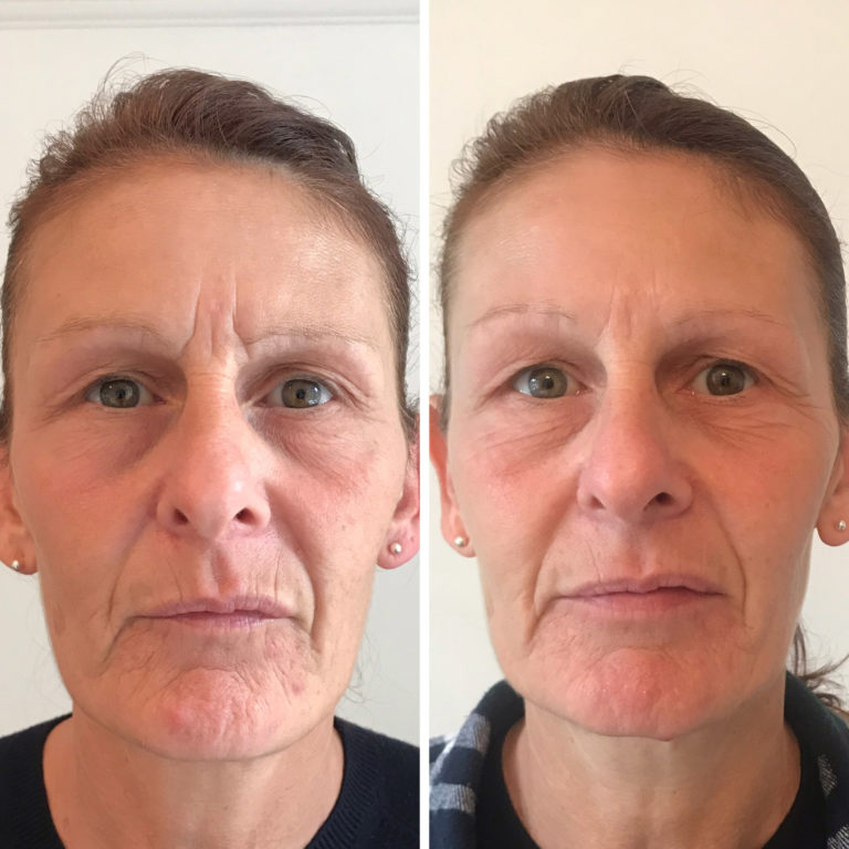 Profhilo before and after treatment