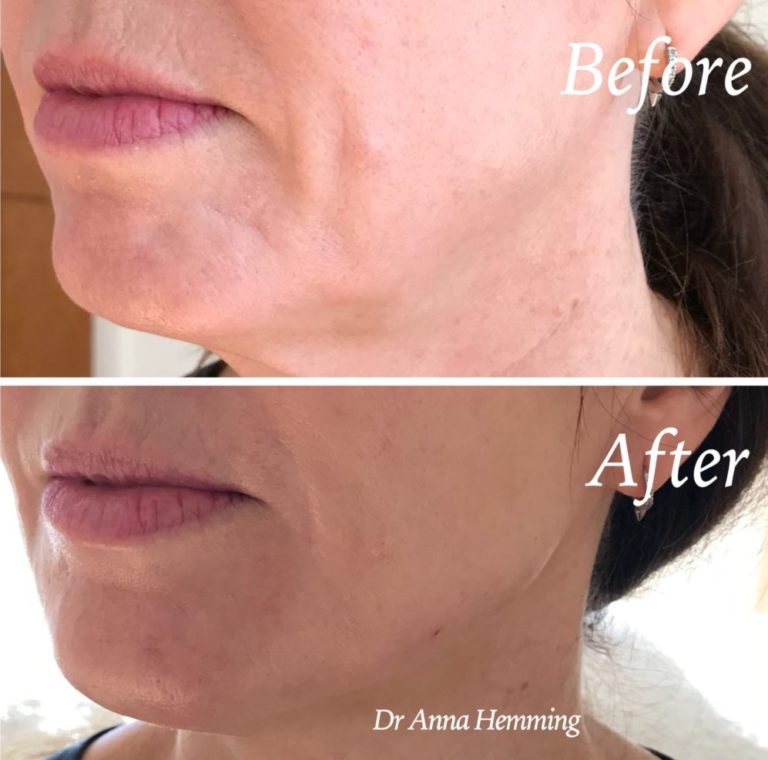 Dermal Filler