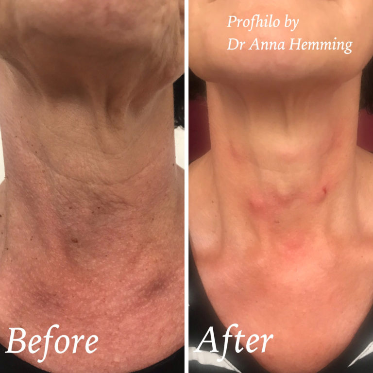 Profhilo before and after treatment