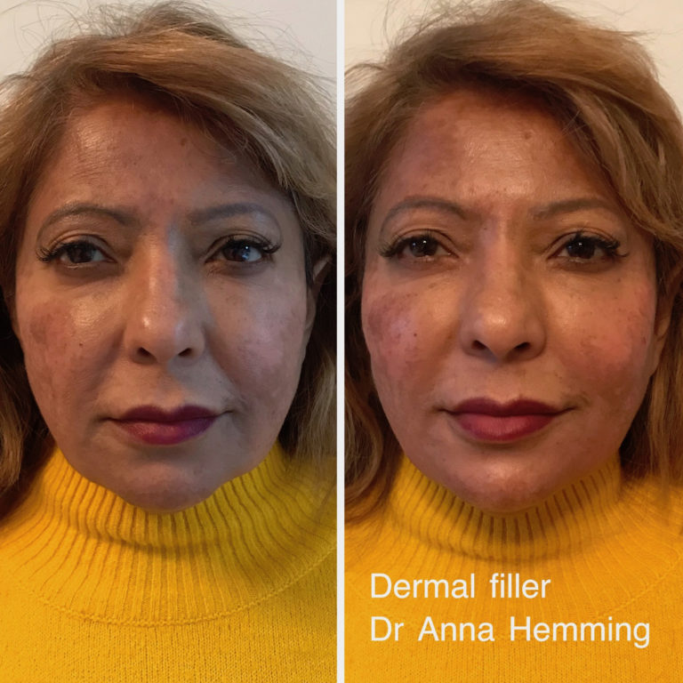 Thames Skin Clinic Dermal Filler Before and After Client 8