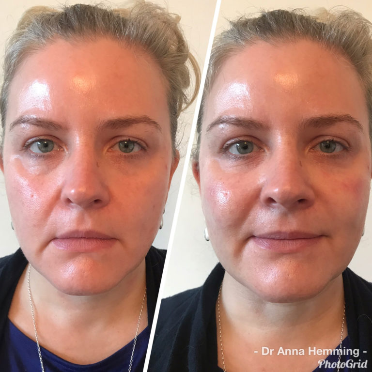 Dermal Filler Before and After Client 3