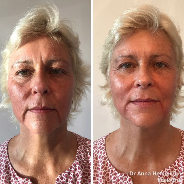 Dermal Filler Before and After