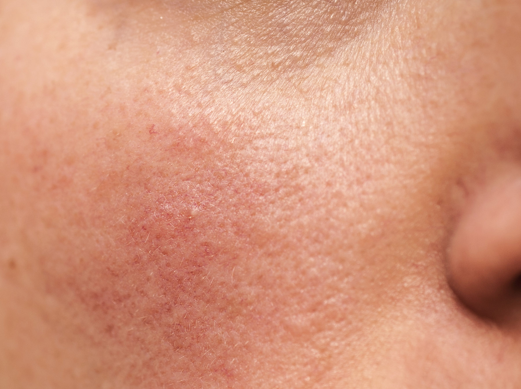 Rosacea And Facial Redness Rosacea Treatment Thames Skin Clinic