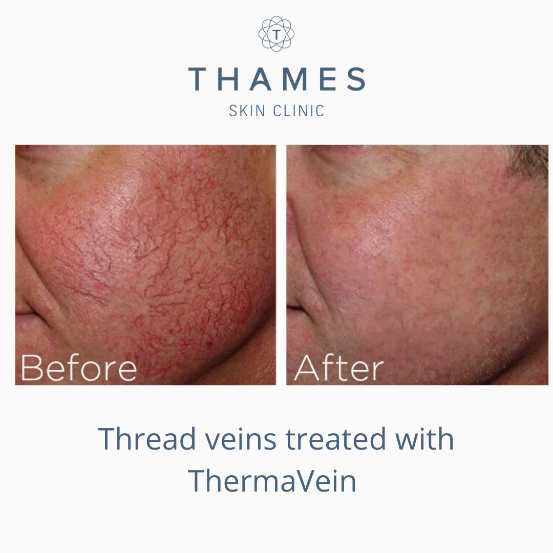 Facial Thread Vein Removal And Consultation Thames Skin Clinic