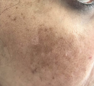 Cheek pigmentation