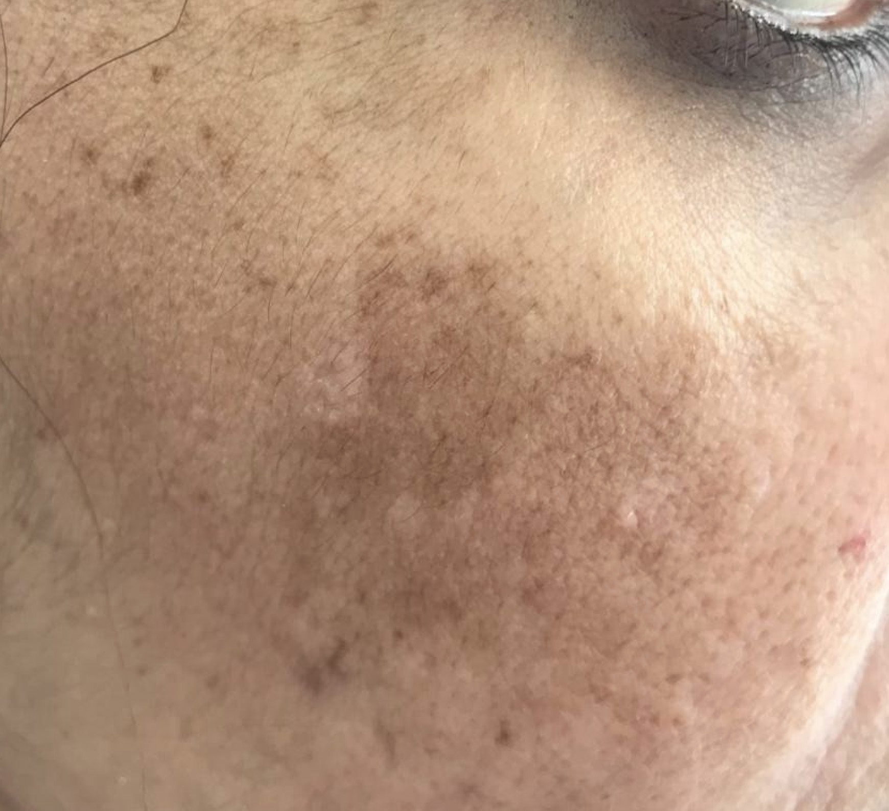 Hyperpigmentation Pigmentation Treatment London Melasma