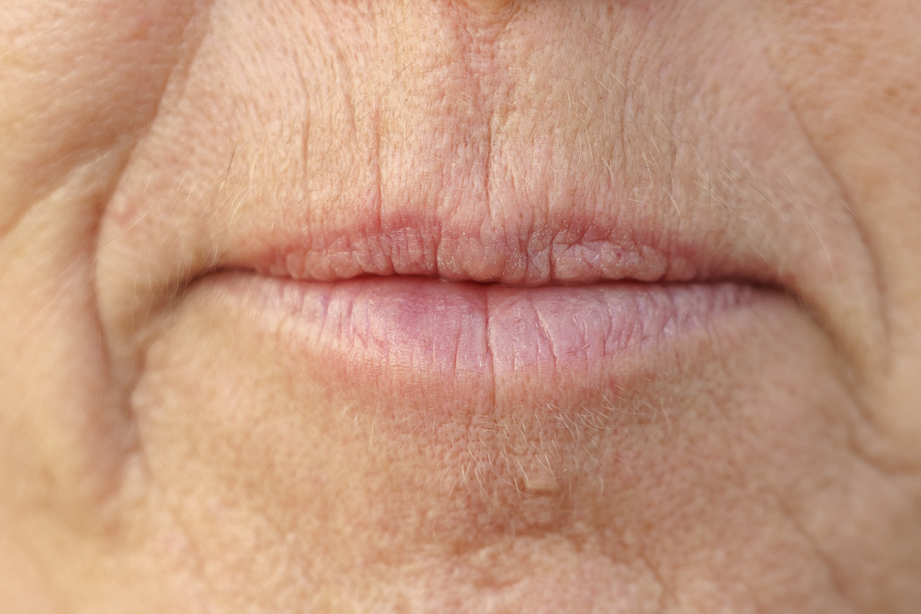 Smokers Lines Treatment In Twickenham Thames Skin Clinic