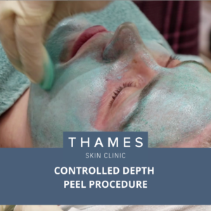Kate having her Controlled Depth Peel