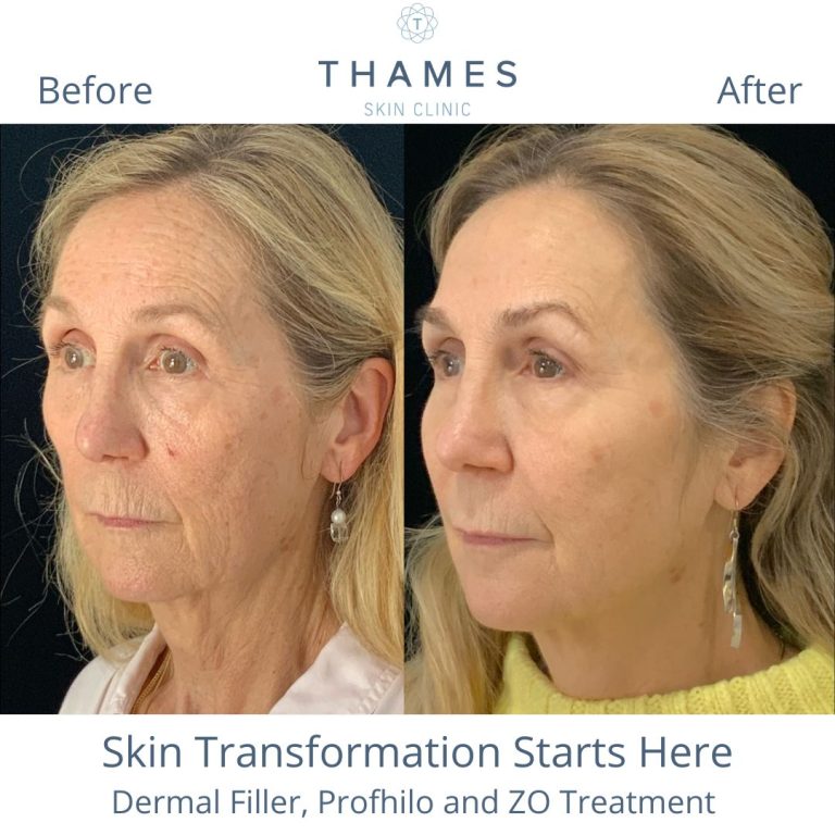 Derma filler, Polynucleotides, Obagi, Profhilo, Before and after at Thames Skin Clinic by Dr Anna Hemming Twickenham skin transformation
