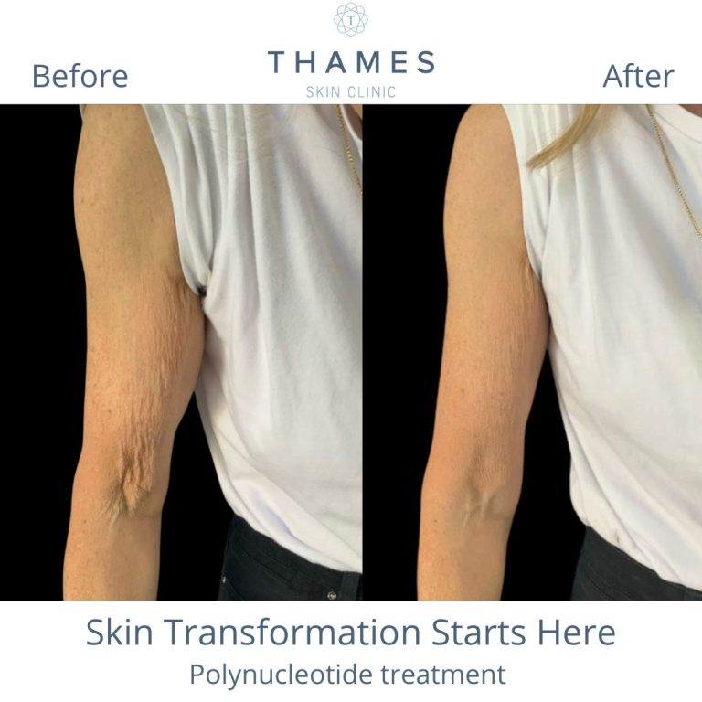 Sagging aged skin before and after treated with polynucleotides