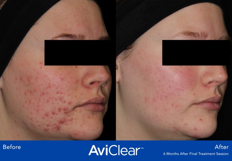 Acne treatment with AviClear Laser Thames Skin Clinic Twickenham London UK Before and After