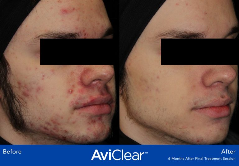 AviClear laser treatment. The best treatment to reduce pimples, acne congestion and oily skin. Acne treatment with AviClear Laser Thames Skin Clinic Twickenham Before and After