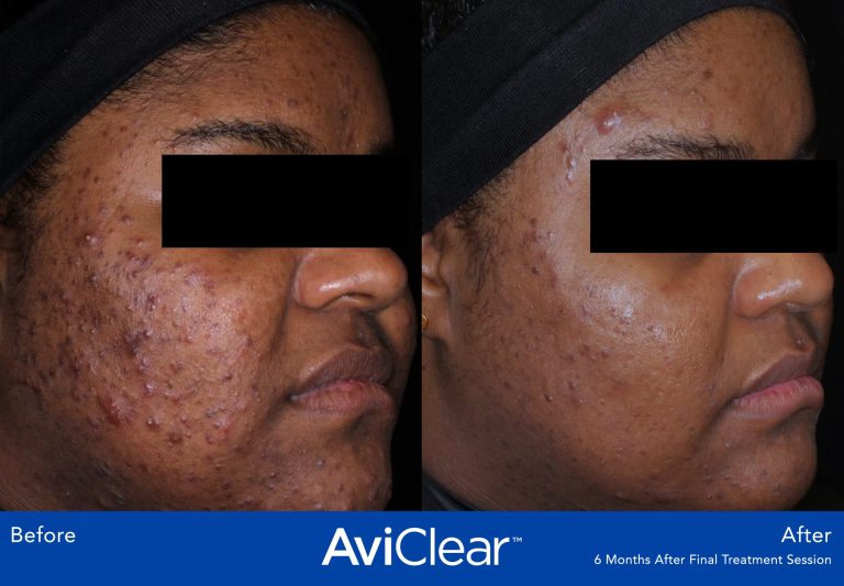 AviClear Laser treatment. Effective acne treatment for all skin types.Thames Skin Clinic Twickenham