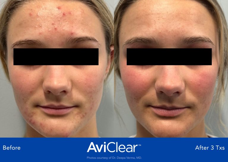 AviClear laser treatment reduces spots, without the need of oral medication. Acne treatment using AviClear is painless and has no side effects. Acne treatment with AviClear Laser Thames Skin Clinic Twickenham Before and After