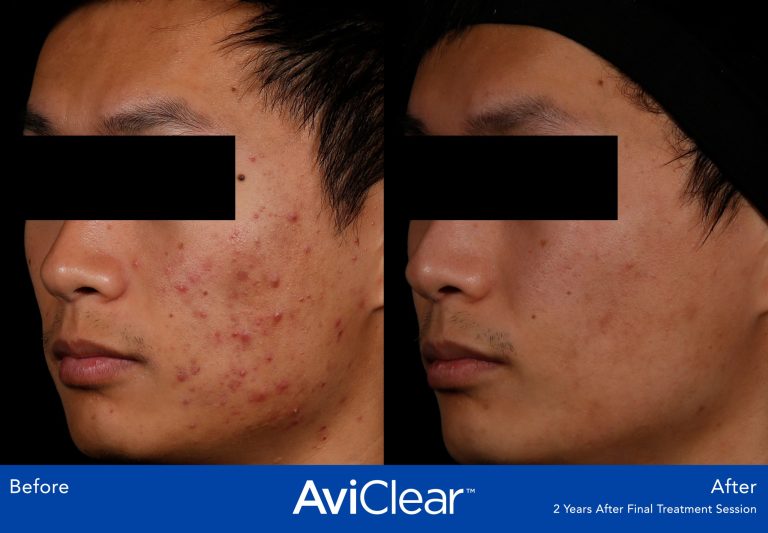 AviClear before and after images showing clear skin 2 years after a course of 3 treatments.