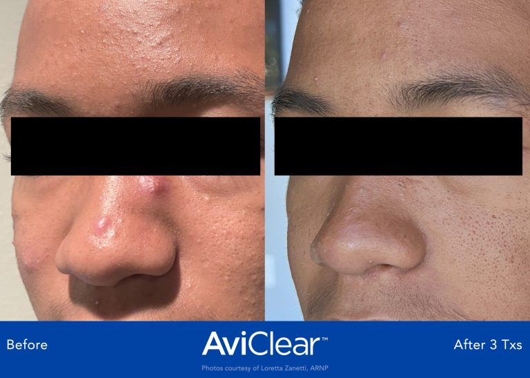 AviClear laser treatment for cystic acne, oily and congested skin. Treat Acne without oral medication or side effects. Thames Skin Clinic Twickenham UK