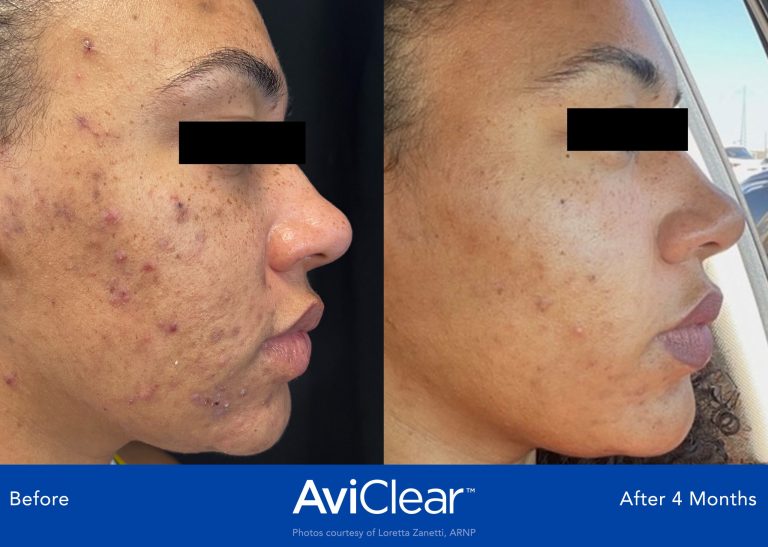 Acne treatment with the new acne laser. AviClear Acne treatment Acne treatment with AviClear Laser Thames Skin Clinic Twickenham Before and After