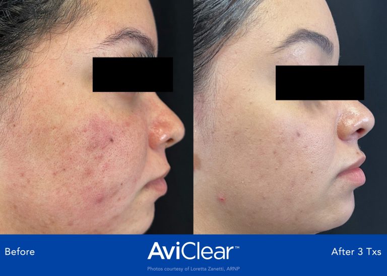AviClear Laser treatment reduce congestion and oily skin Thames Skin Clinic Twickenham