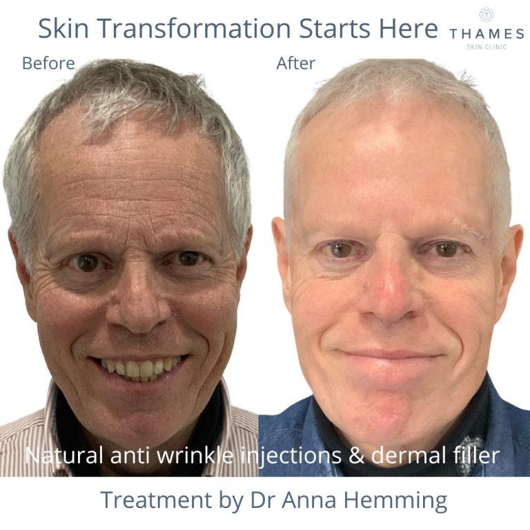 Dermal Filler treatment at Thames Skin Clinic Twickenham UK anti wrinkle injections neurotoxins