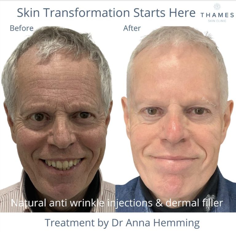 Dermal Filler treatment at Thames Skin Clinic Twickenham UK