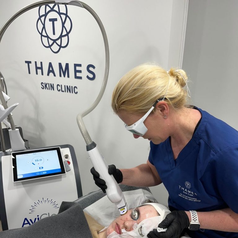 Dr Anna Hemming now offers AviClear at Thames Skin Clinic