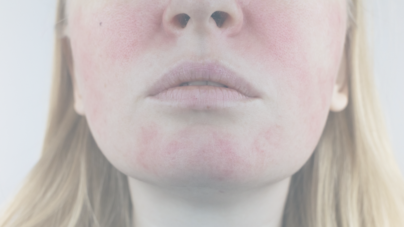 rosacea awareness month