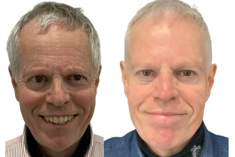 Anti-wrinkle injections before and after