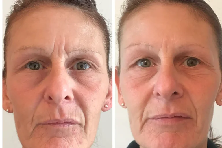 Anti-wrinkle injections before and after