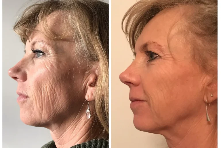 Anti-wrinkle injections before and after