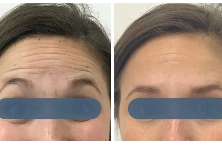 Anti-wrinkle injections before and after