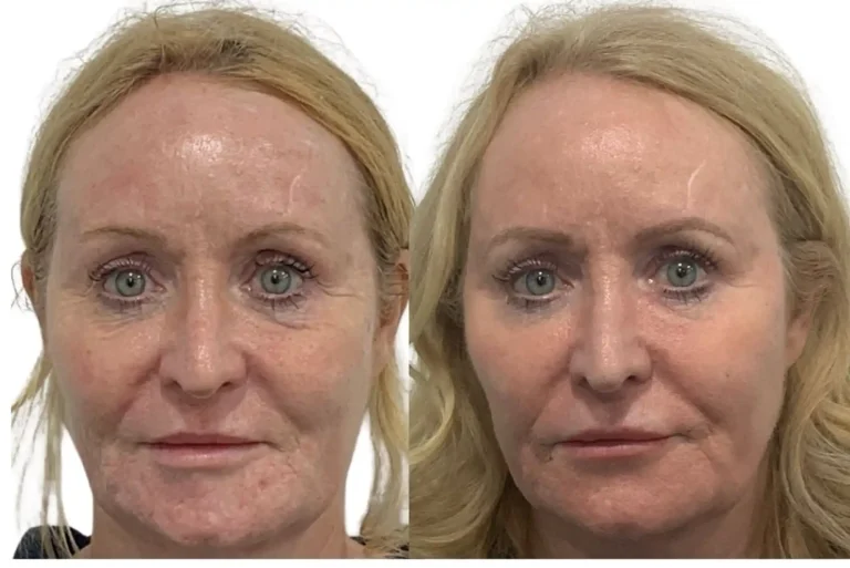 Dermal Filler before and after