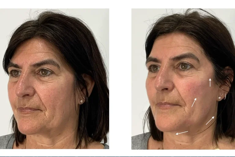 Dermal Filler before and after