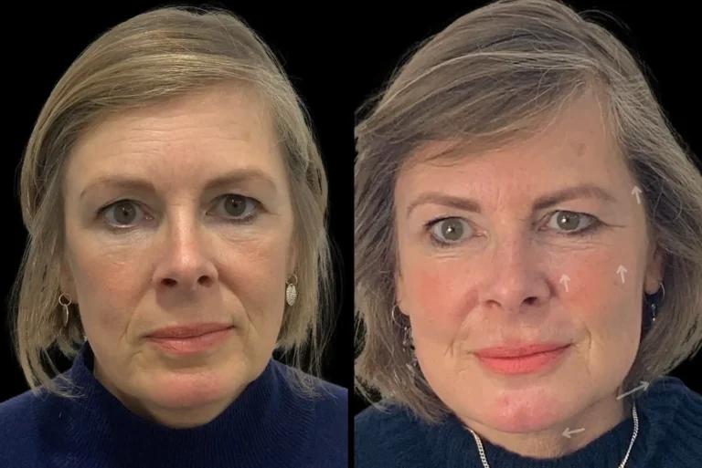 Dermal Filler before and after