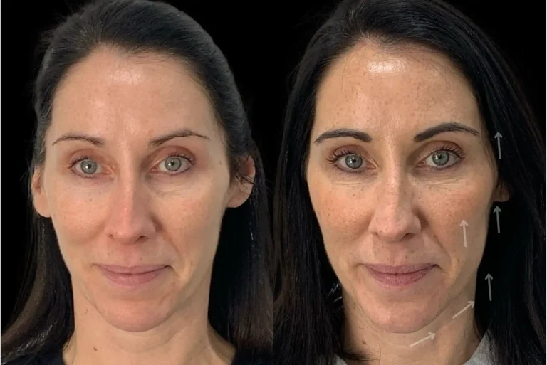 Dermal Filler before and after