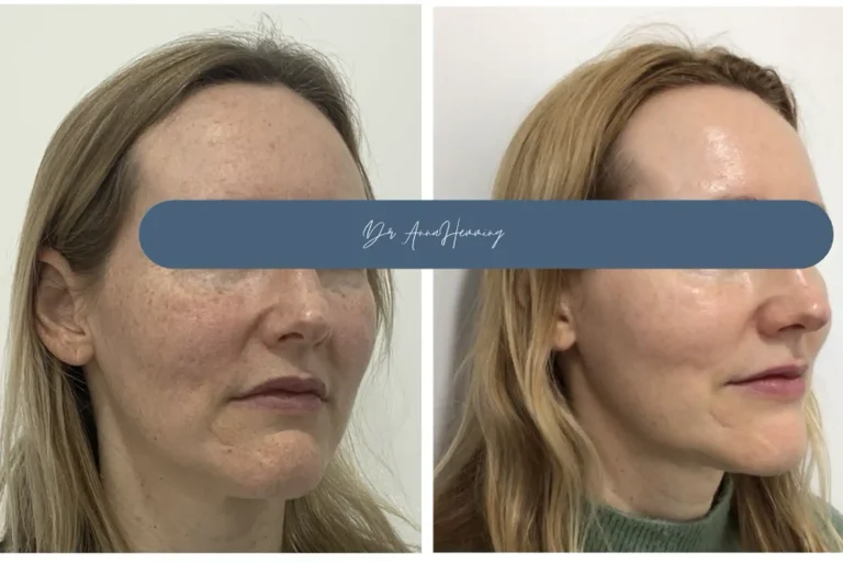 Our Excel V+ Cutera laser is specifically designed for treating hyperpigmentation. It treats conditions like brown-red dyschromia, age spots, lentigo and other forms of pigmentation. The laser’s targeted energy is absorbed by the pigmented cells, breaking them down and allowing the body to naturally eliminate them. This advanced pigmentation laser treatment in London ensures precise, comfortable treatment with minimal impact on your skin.