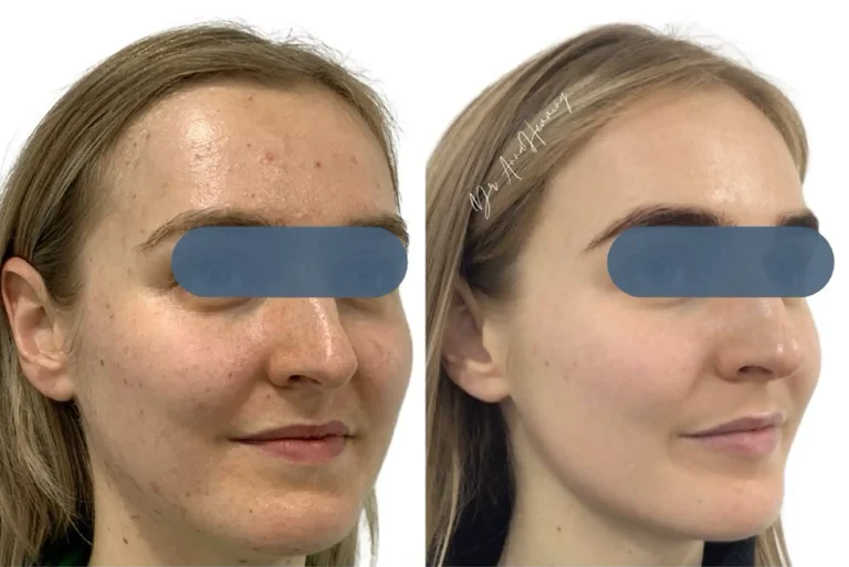 Pigmentation Before and After