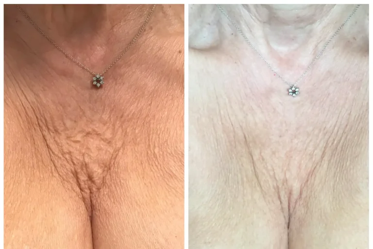 Profhilo Before and After