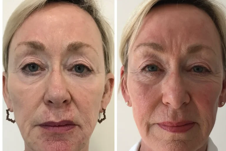 Profhilo Before and After