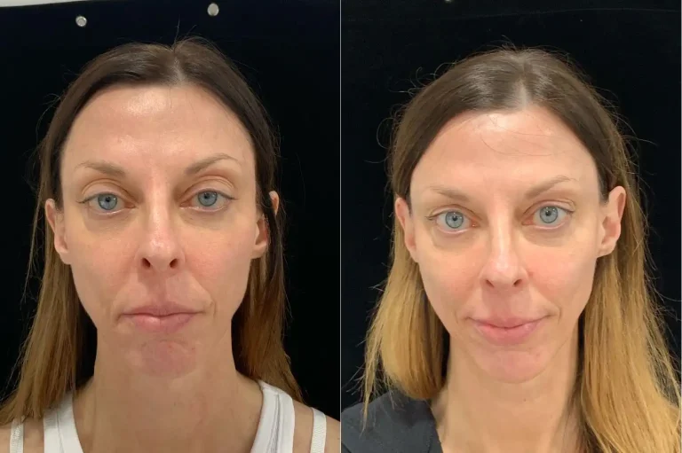Cellenis PRP Dermal Filler Before and After