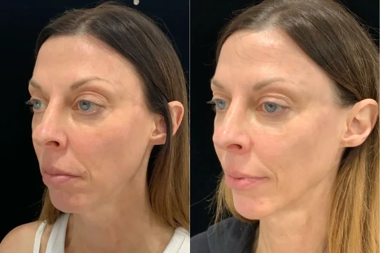 Cellenis PRP Dermal Filler Before and After