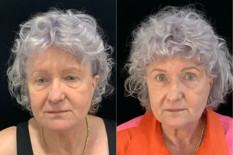Cellenis PRP Dermal Filler Before and After