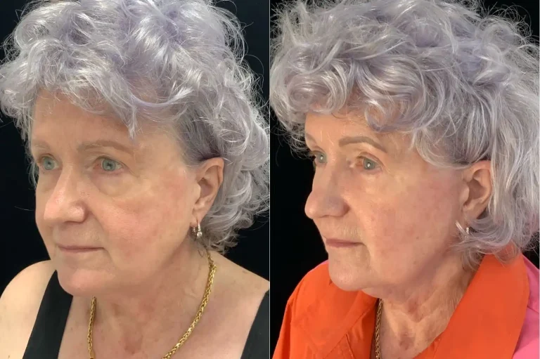 Cellenis PRP Dermal Filler Before and After