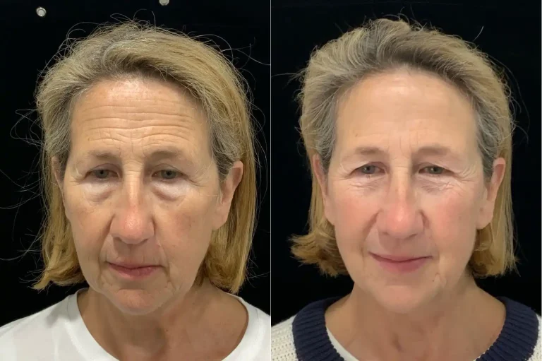 Cellenis PRP Dermal Filler Before and After
