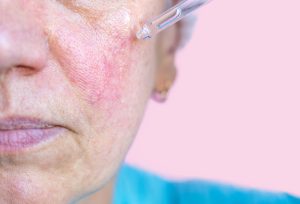 Older lady with rosacea